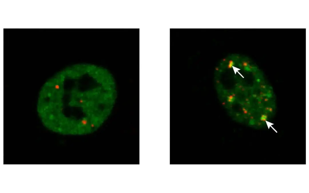 ALS: Zelluläres Reparatursystem könnte Protein-Aggregation verhindern