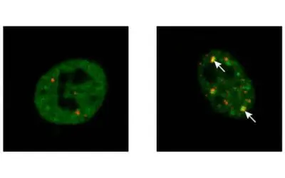 ALS: Zelluläres Reparatursystem könnte Protein-Aggregation verhindern