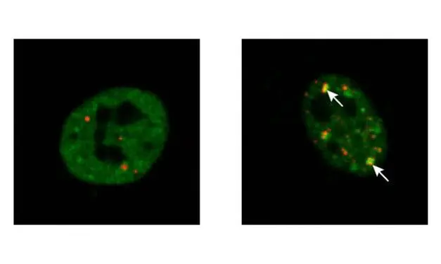 ALS: Zelluläres Reparatursystem könnte Protein-Aggregation verhindern