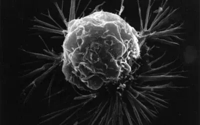 HSF2-Mechanismus im Fortschreiten von Brustkrebs entdeckt
