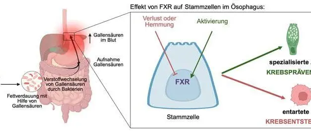 FXR: Neue Erkenntnisse zur Vorbeugung von Speiseröhrenkrebs