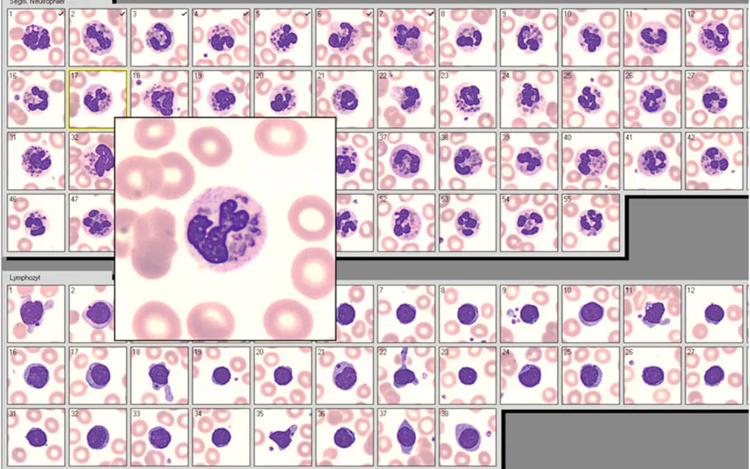 Giant granules in white blood cells