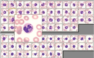 Giant granules in white blood cells