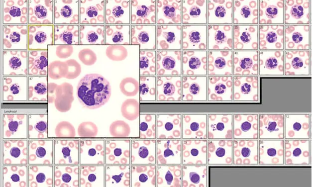 Giant granules in white blood cells
