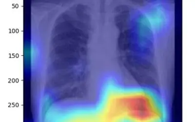 KI-Modell erkennt Fettleber anhand von Röntgenbildern