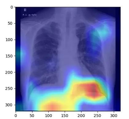 KI-Entscheidungsprozess mit Röntgenbildern der Brust: Röntgenbilder von Herz und Lunge erfassen auch Teile der Leber, so dass Deep-Learning-Modelle eine Fettlebererkrankung erkennen können. Credits: Osaka Metropolitan University