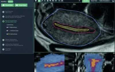 Diagnostik: RACOON FADEN revolutioniert Früherkennung von Adenomyose
