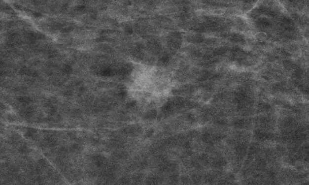 Studie belegt: Mammografie-Screening senkt Brustkrebssterblichkeit deutlich