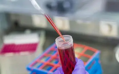 Neues Verfahren zur Früherkennung von Bauchspeicheldrüsenkrebs entwickelt