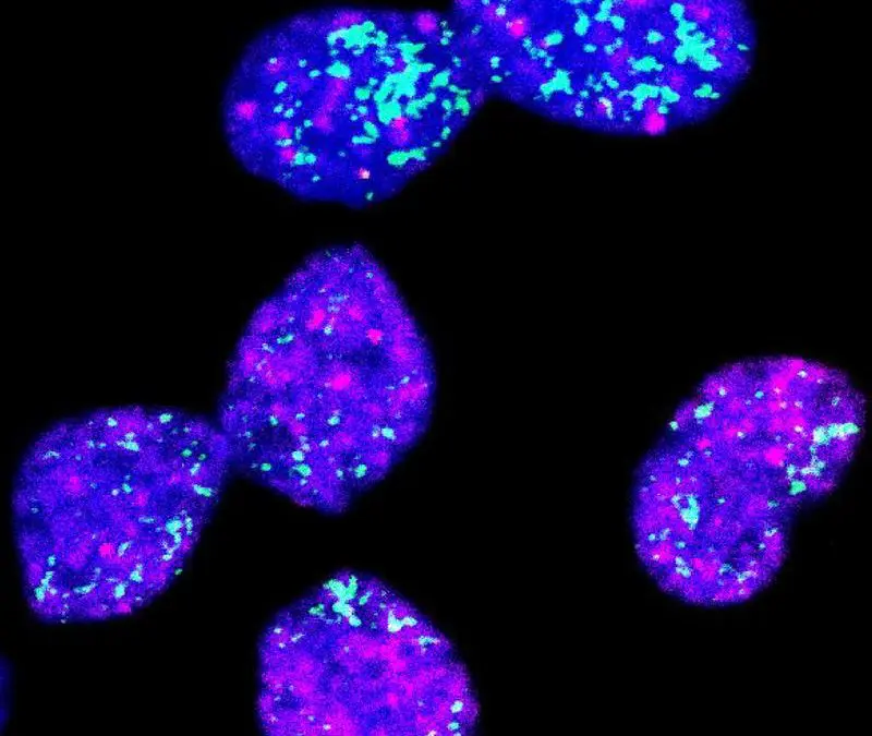 Neuer Therapieansatz gegen aggressive Neuroblastome entdeckt