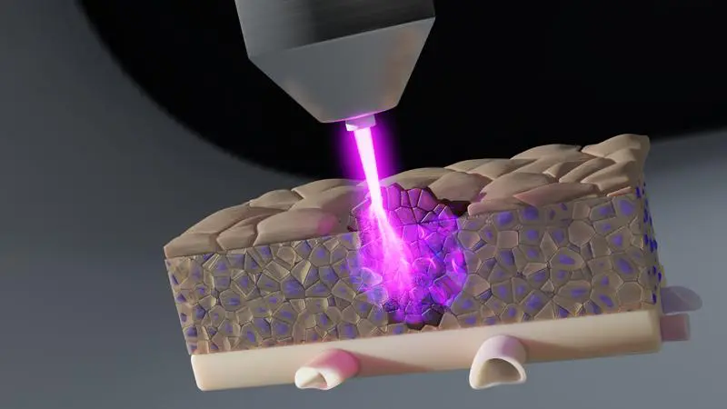 Reaktive Sauerstoffmoleküle, die durch die Plasmatherapie gebildet werden, können tief ins Gewebe eindringen. So können Tumorzellen auch in tieferen Gewebeschichten erreicht und abgetötet werden. | Copyright: INP