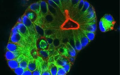 Neue Hoffnung für Menschen mit Enddarmkrebs