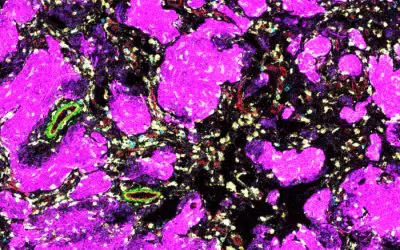 Studie zu kindlichen Hirntumoren: Tumor-Mikroumgebung beeinflusst Therapieerfolg