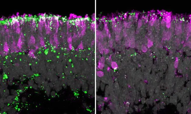 Humane Organoide: Gentherapie gegen Erblindung bei Kinderdemenz erfolgreich getestet