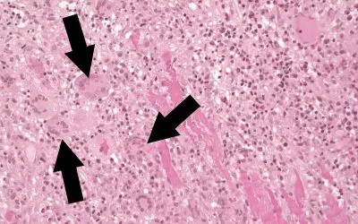 Fulminante Myokarditis: Studie liefert Ansätze für bessere Diagnostik und Therapie