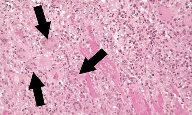 Fulminante Myokarditis: Studie liefert Ansätze für bessere Diagnostik und Therapie