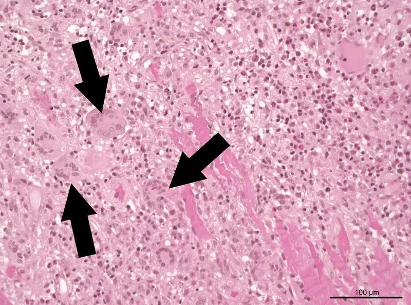 In der Mikroskop-Aufnahme einer Gewebeprobe aus einem erkrankten Herzmuskel sind Riesenzellen zu sehen, die der Riesenzellen-Myokarditis ihren Namen geben. | Quelle: Prof. Dr. K. Klingel | Copyright: Kardiopathologie, Universitätsklinikum Tübingen