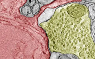 Krebszellen: Synapsenbildung mit Nervenzellen fördert Tumorwachstum