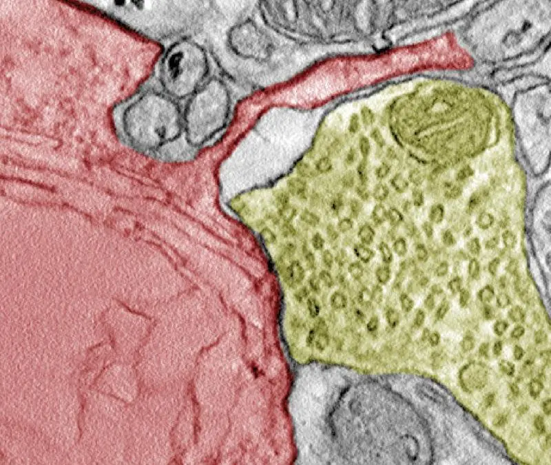 Krebszellen: Synapsenbildung mit Nervenzellen fördert Tumorwachstum