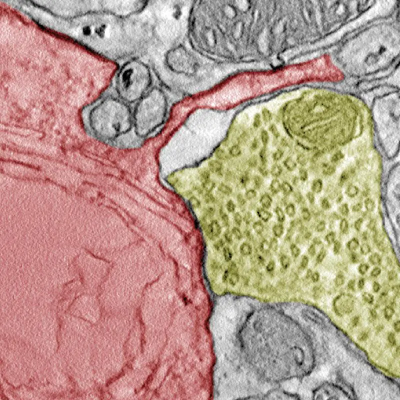 Elektronenmikroskopische Aufnahme eines SCLC-Allotransplantats aus einem Mäusegehirn, die einen synaptischen Kontakt zwischen einer Krebszelle (rot) und einem neuronalen Terminal (gelb) zeigt. | Quelle: Chihab, Ndoci und Gaedke | Copyright: Universität zu Köln 