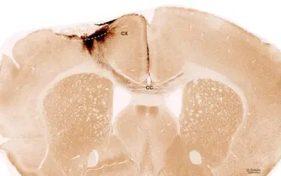 Stammzellen reparieren Schlaganfall-Schäden