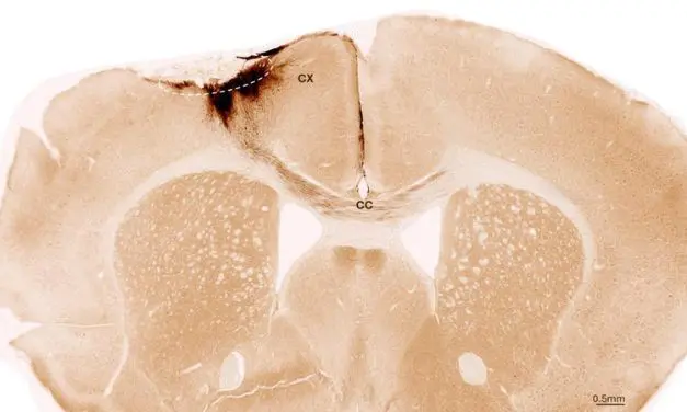 Stammzellen reparieren Schlaganfall-Schäden