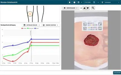 Würzburger Forschungsteam entwickelt KI-App zur Überwachung chronischer Wunden