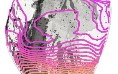 Neue Bildgebung enthüllt Ursachen für plötzlichen Herztod