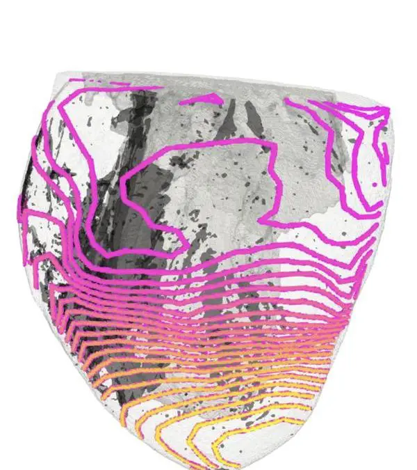 Neue Bildgebung enthüllt Ursachen für plötzlichen Herztod