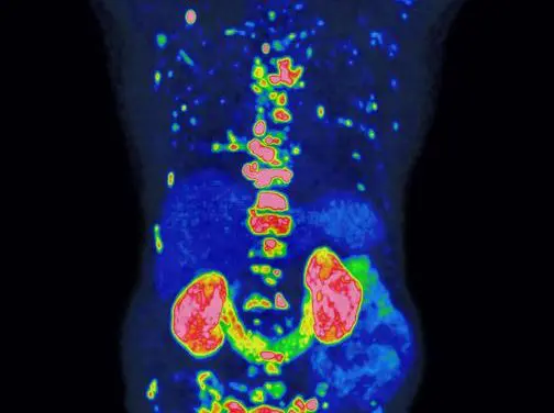 Preis für bahnbrechende Methode zur Prognose und Therapie von Prostatakrebs