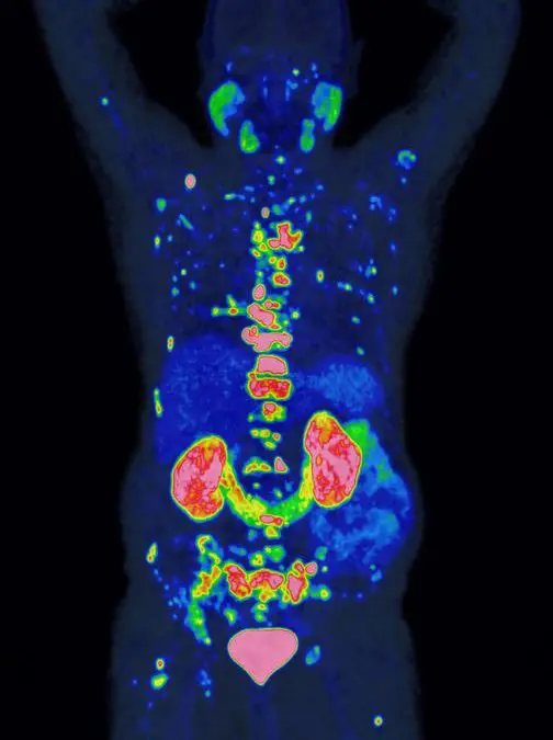 Preis für bahnbrechende Methode zur Prognose und Therapie von Prostatakrebs