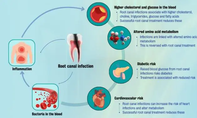 Wurzelbehandlungen senken das Risiko für Herzerkrankungen und Diabetes