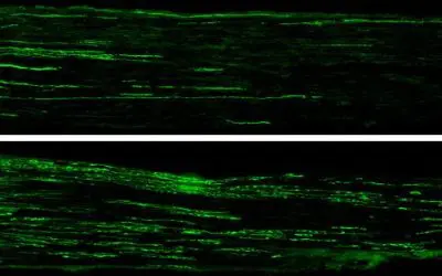 Nervenregeneration bei Diabetes: Neues Peptid könnte Therapie revolutionieren
