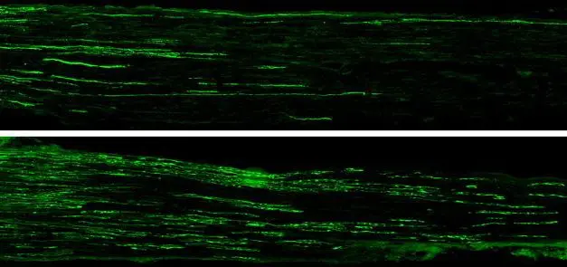 Nervenregeneration bei Diabetes: Neues Peptid könnte Therapie revolutionieren