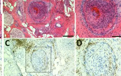 Europäisches Konsortium erforscht Ursachen neuropathischer Schmerzen