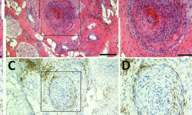 Europäisches Konsortium erforscht Ursachen neuropathischer Schmerzen