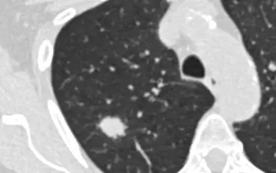 Studie fordert erweiterte Kriterien für Lungenkrebs-Früherkennung
