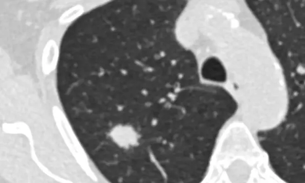 Studie fordert erweiterte Kriterien für Lungenkrebs-Früherkennung