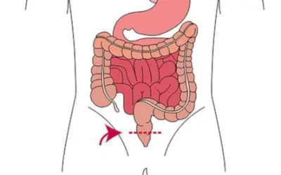 Neue Sensorfolie revolutioniert Früherkennung bei Darmoperationen