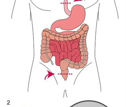 Neue Sensorfolie revolutioniert Früherkennung bei Darmoperationen
