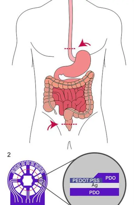 Neue Sensorfolie revolutioniert Früherkennung bei Darmoperationen