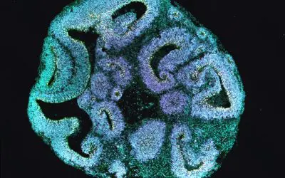 Hirn-Organoide klären Ursachen seltener Entwicklungsstörung