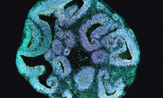 Hirn-Organoide klären Ursachen seltener Entwicklungsstörung