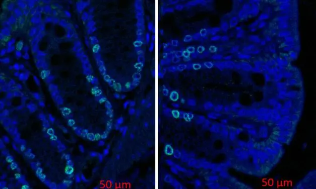 Sekundäre Gallensäuren aus Darmbakterien fördern Dickdarmkrebs