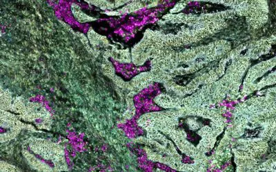 Darmkrebs mit KRAS-Mutation reprogrammiert Neutrophile bereits im Knochenmark