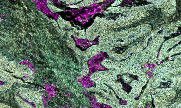 Darmkrebs mit KRAS-Mutation reprogrammiert Neutrophile bereits im Knochenmark