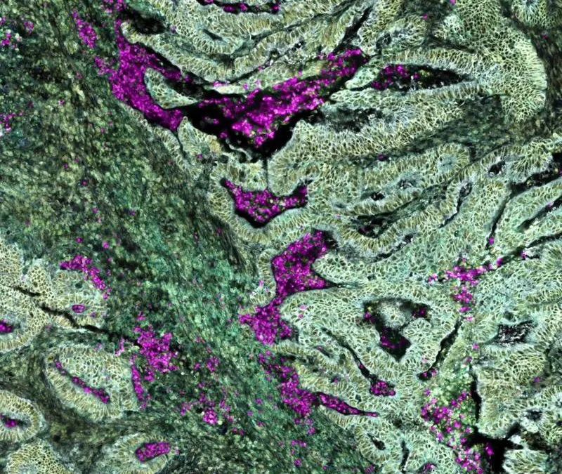 Darmkrebs mit KRAS-Mutation reprogrammiert Neutrophile bereits im Knochenmark