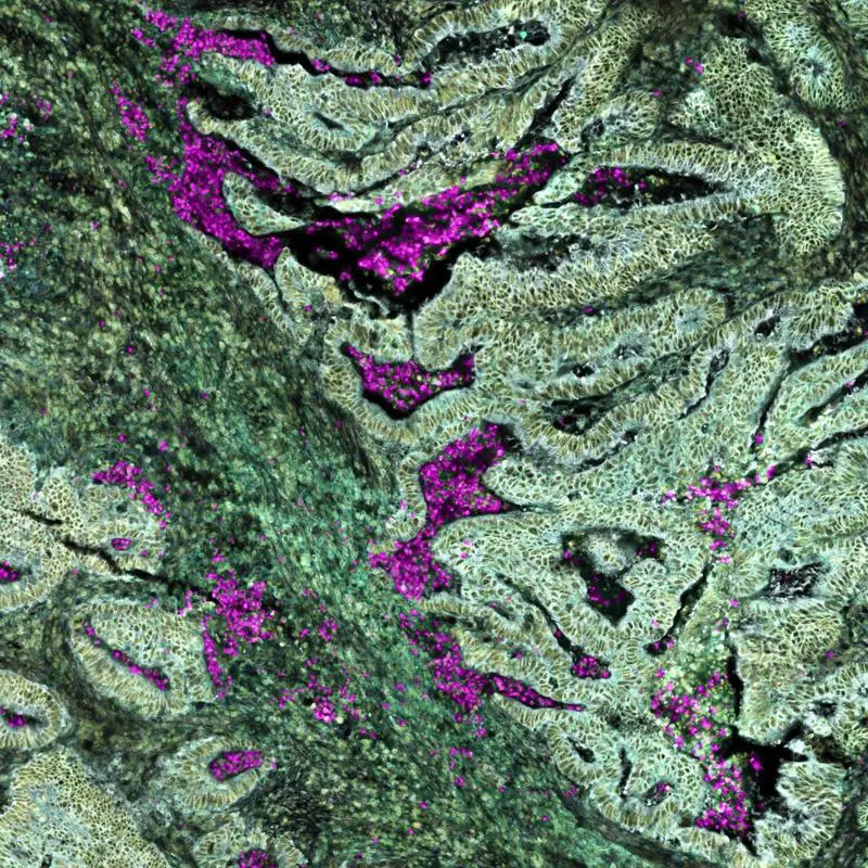 Die Visualisierung von Darmkrebs mittels Spatial Transcriptomics (10X Genomics Xenium Plattform) zeigt eine komplexe Gewebearchitektur mit funktionellen zellulären Nischen, in welchen sich Neutrophile (pink) anhäufen. | Quelle: Alexander Kirchmair | Copyright: Alexander Kirchmair