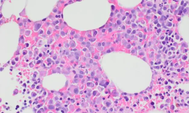 Verbesserte CAR-T-Zelltherapie erkennt Myelomzellen an zwei Merkmalen