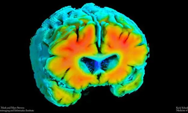 Neue Marker könnten Alzheimer-Risiko frühzeitig erkennen